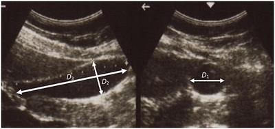 A Pointwise Method for Identifying Biomechanical Heterogeneity of the Human Gallbladder